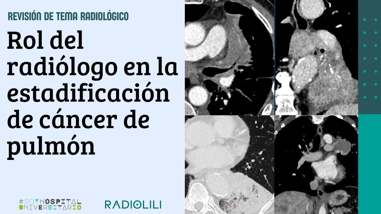 52° Encuentro Académico de Radiología: Rol del radiólogo en la estadificación de cáncer de pulmón