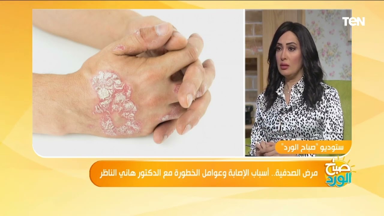 ما هي الصدفية وأسبابها؟.. الدكتور هاني الناظر يجيب