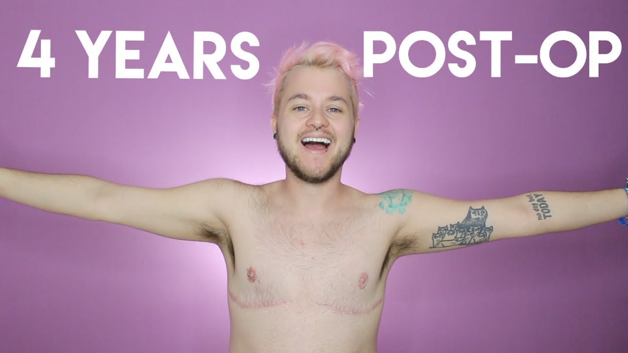4 YEARS POST-OP (FTM TOP SURGERY)