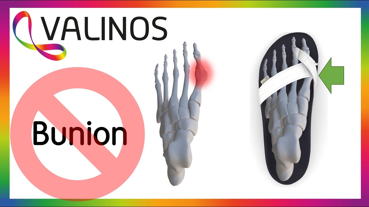 valinos  CROSS - 2024 collection // sandals against Hallux Valgus and Bunions
