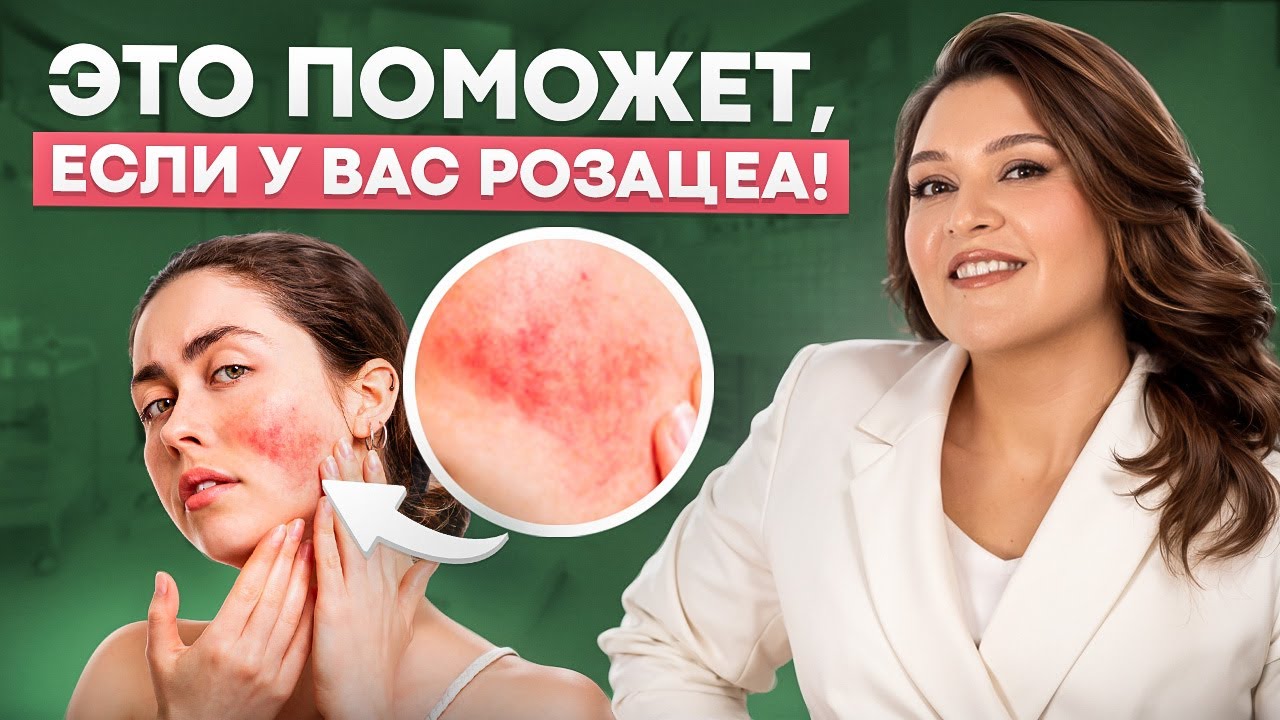 Что делать, если у вас РОЗАЦЕА? Лучшие средства и процедуры для улучшения кожи в этом видео!