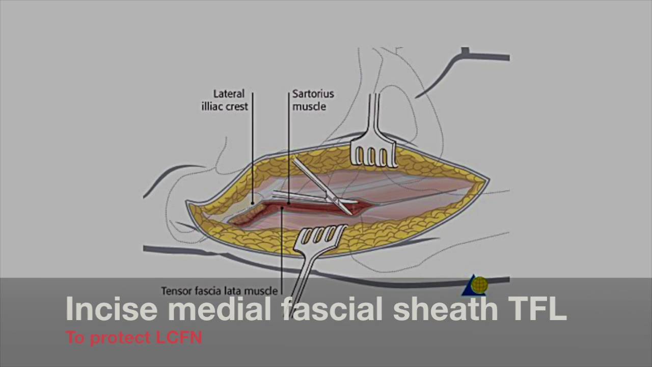 Hip Anterior Approach