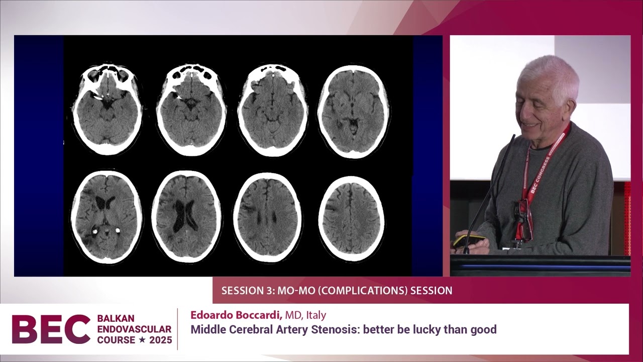 BEC 2025 | Middle Cerebral Artery Stenosis: better be lucky than good | Edoardo Boccardi