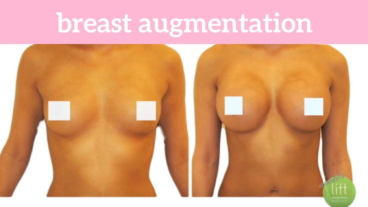 Ashley Visits Lift MD Aesthetics for a Breast Augmentation by Dr. Garo Kassabian