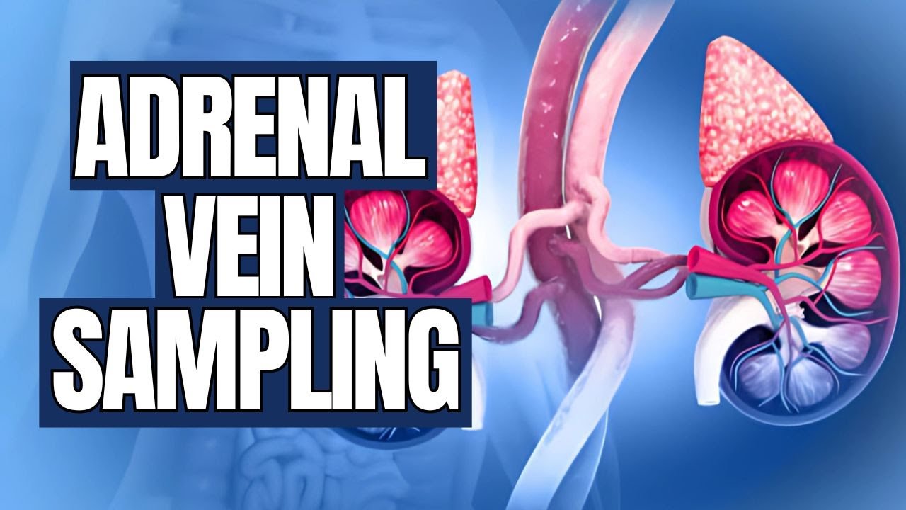 Adrenal Vein Sampling 1