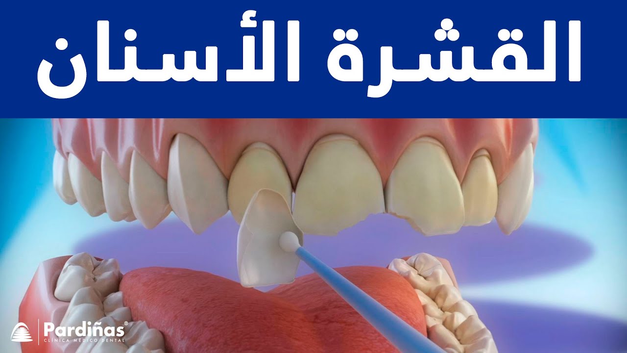القشرة الأسنان ©