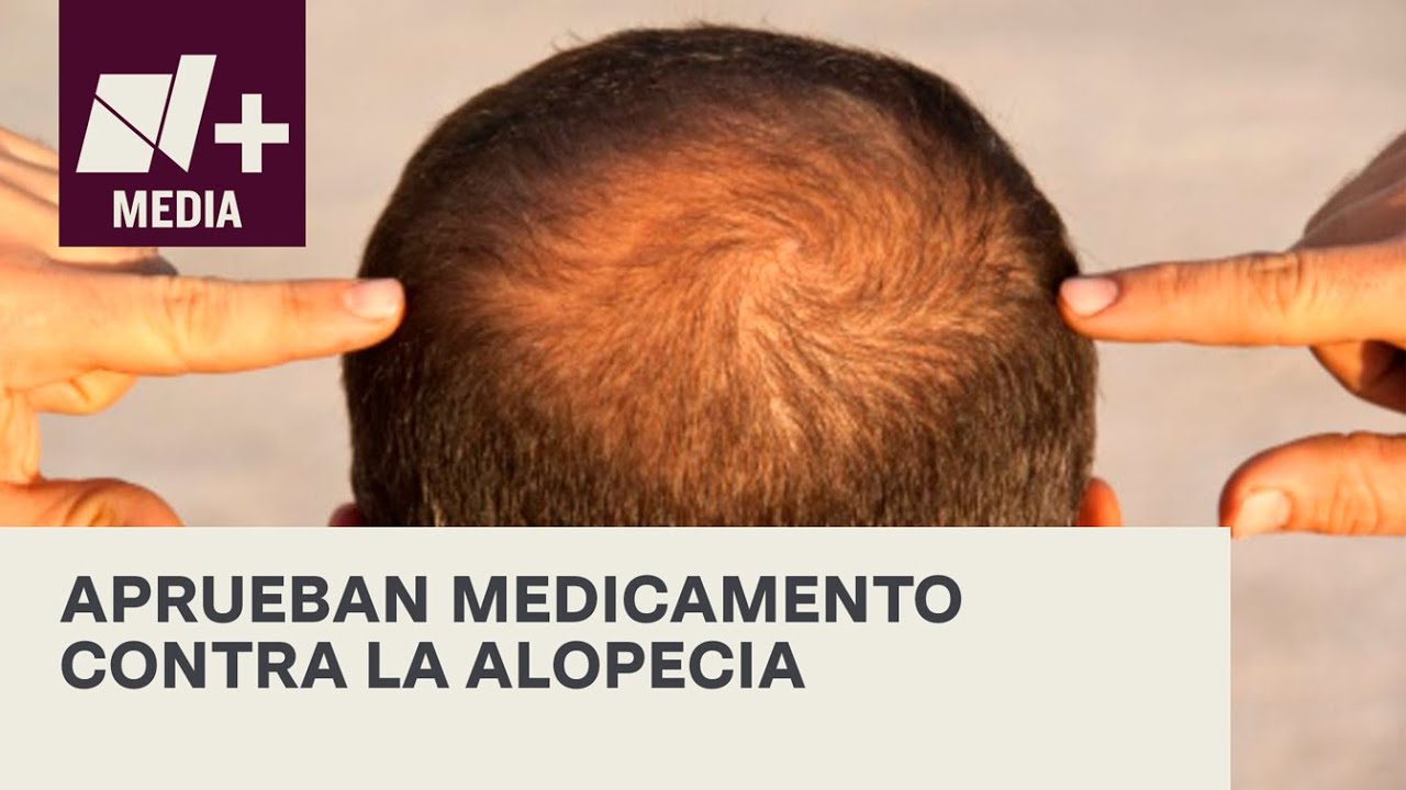 Aprueba FDA primer medicamento contra la alopecia - Bien y de Buenas
