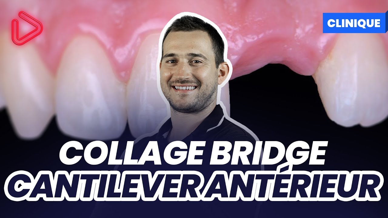 COLLAGE DE BRIDGE CANTILEVER EN REMPLACEMENT  D'UNE INCISIVE CENTRALE