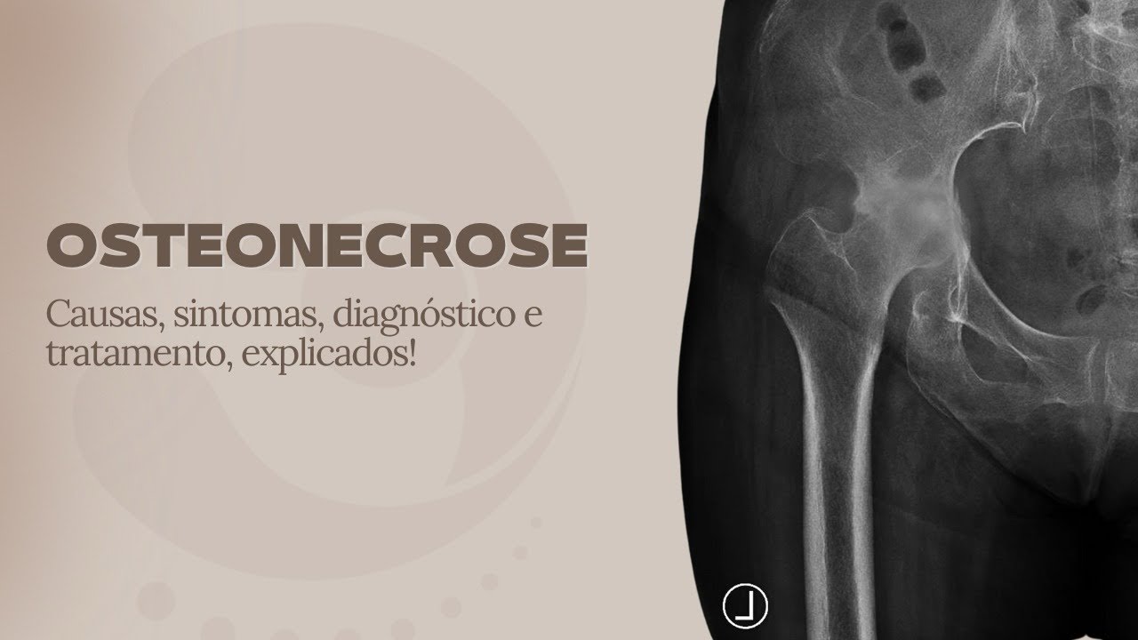 Osteonecrose- Causas, sintomas, diagnóstico e tratamento- Dr. Isaías Chaves