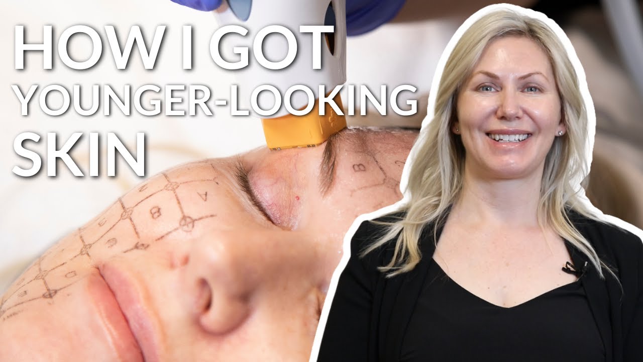 How to get younger looking Skin FAST! (The Lucere ThermaFrax really changed me...)