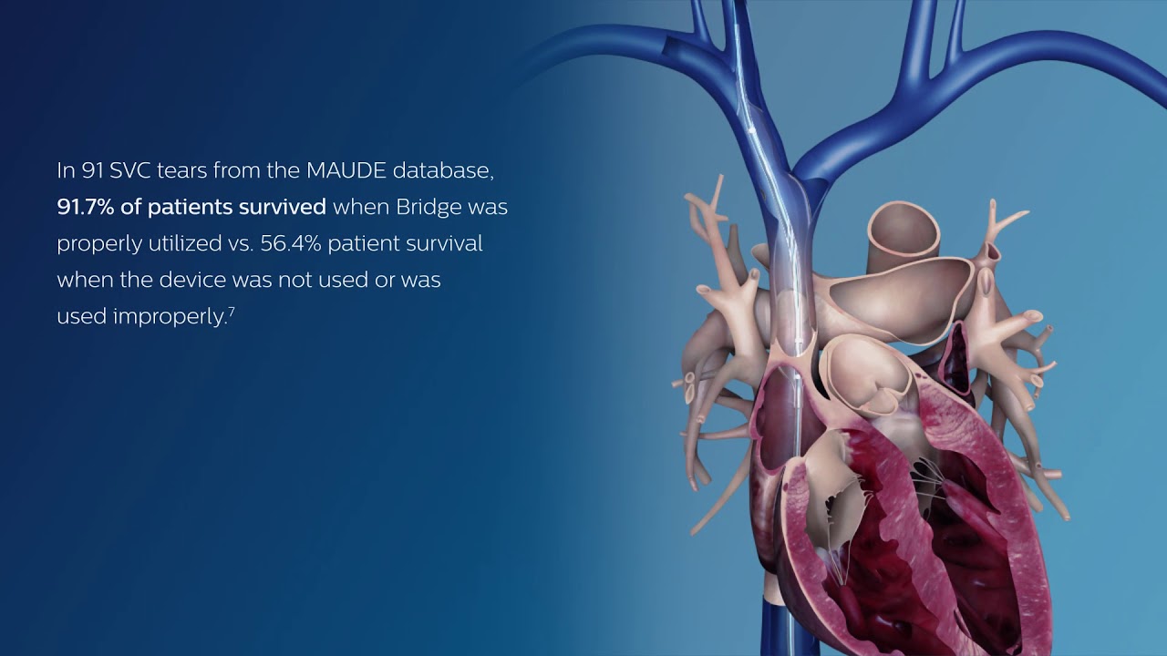 Bridge Occlusion Balloon Animation