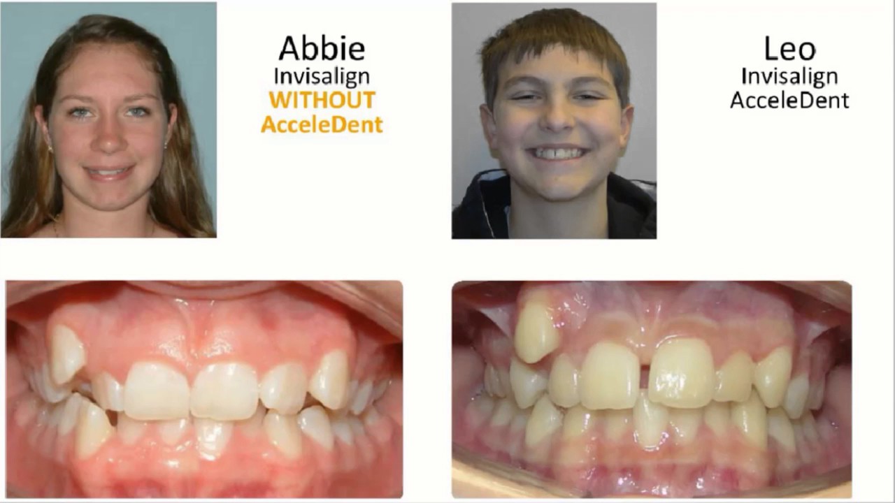 Dr. Manal Ibrahim Invisalign Case Review Blocked Out Teeth (Twin Teeth) with AcceleDent