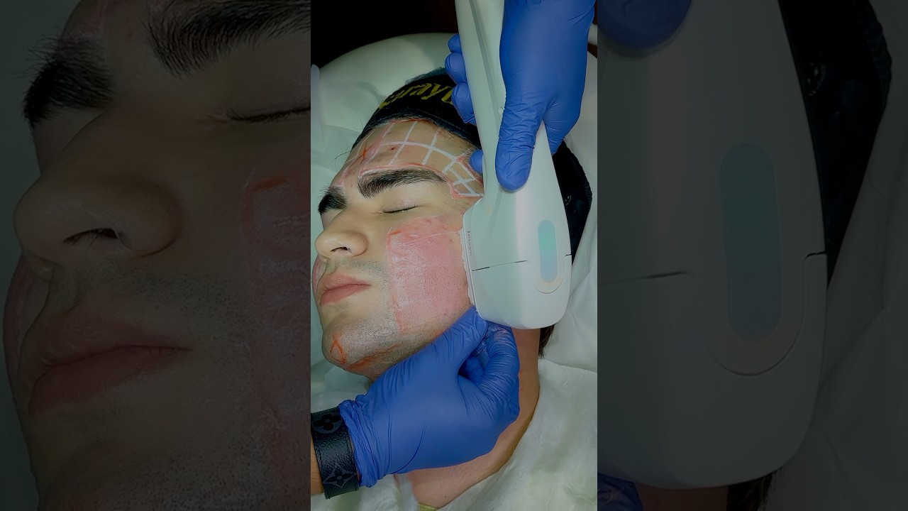 Non Surgical Face Lift With HIFU | Sarayu Clinics #skintightening #hifu