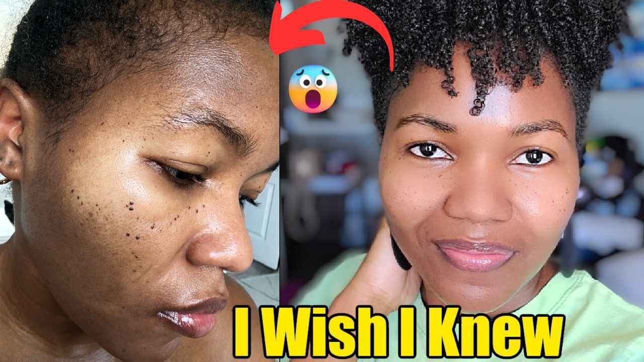 Tretinoin Destroyed My Skin & How I fixed It | Tretinoin Before & After
