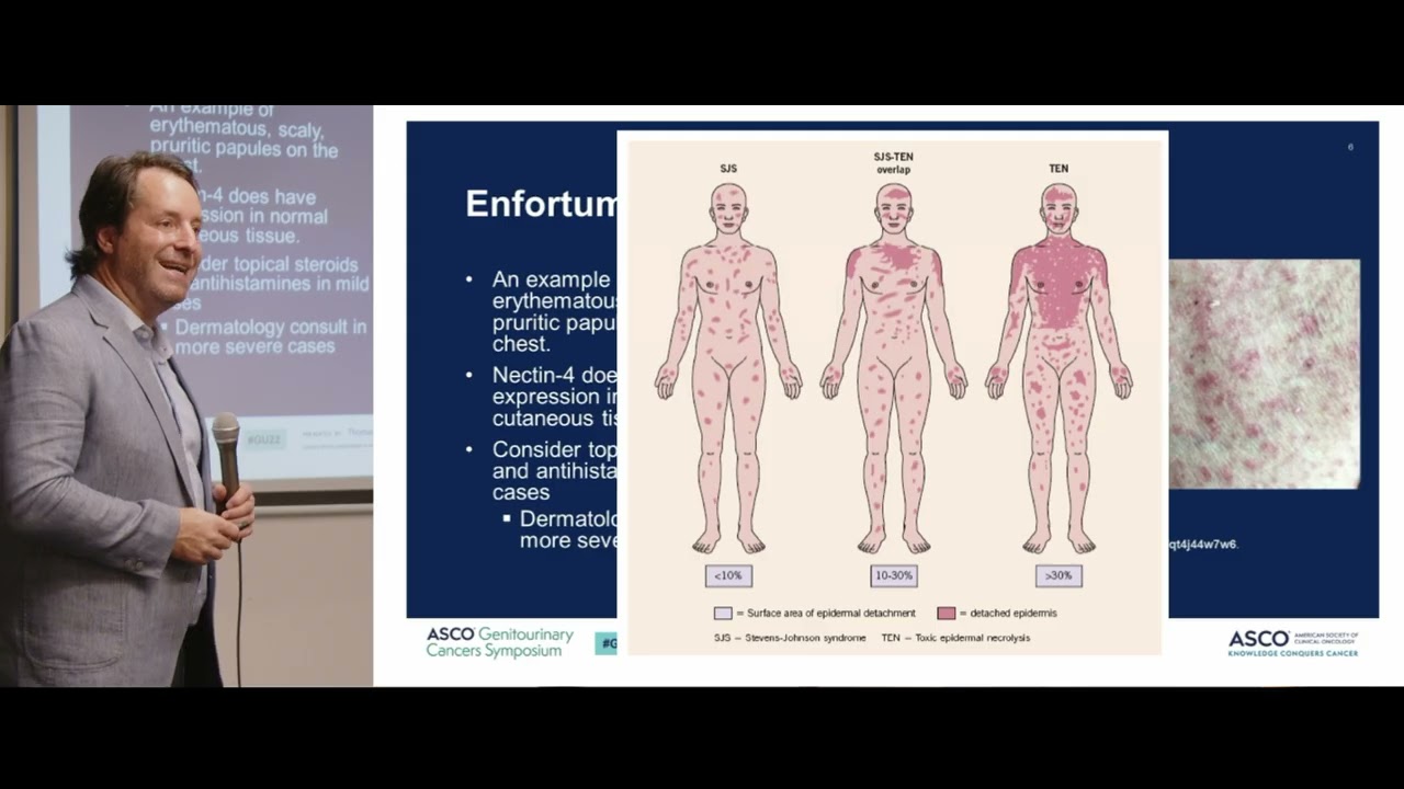 Carcinoma uroterial - Preceptorship Uro Oncología