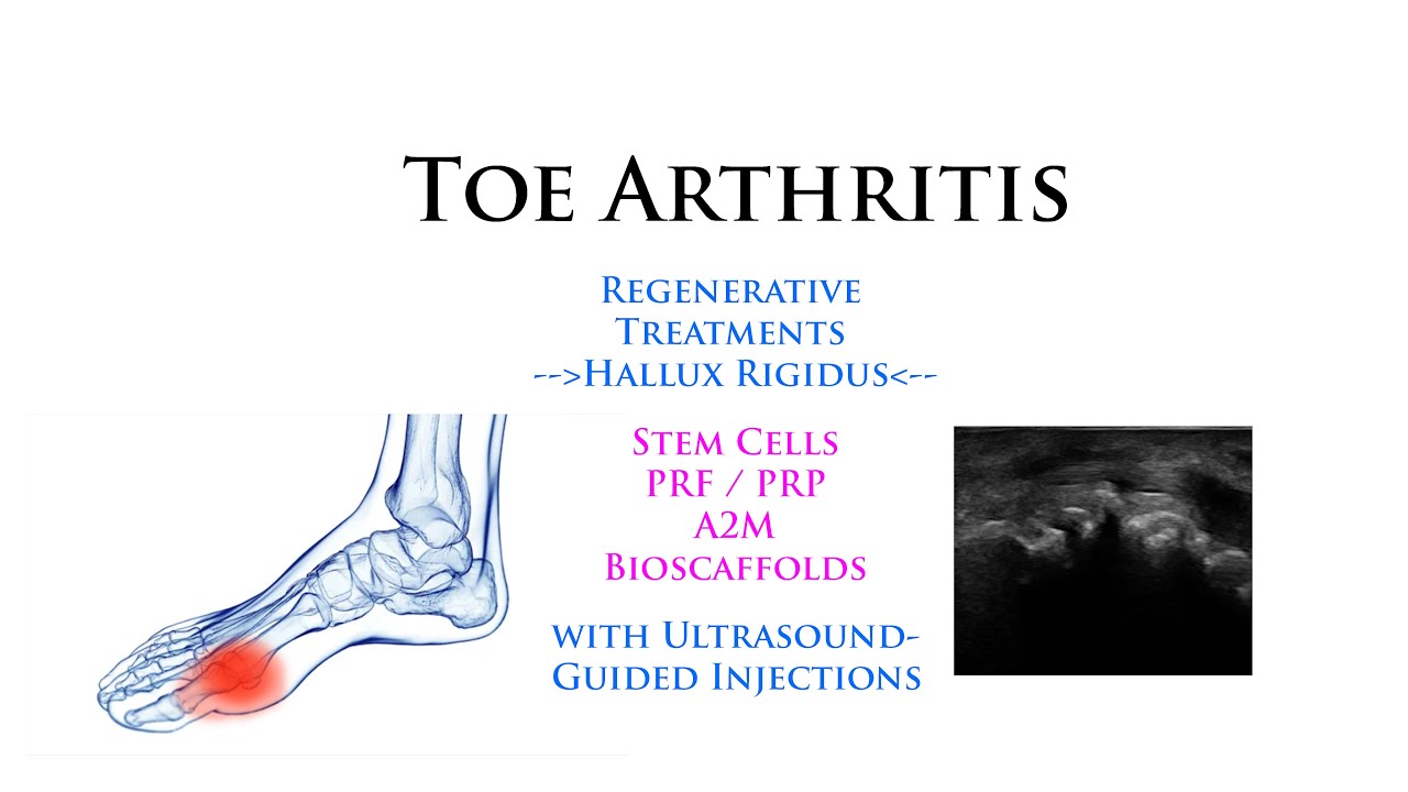 Toe Arthritis (MTP): Regenerative Stem Cells with Ultrasound-Guided Minimally-Invasive Injections