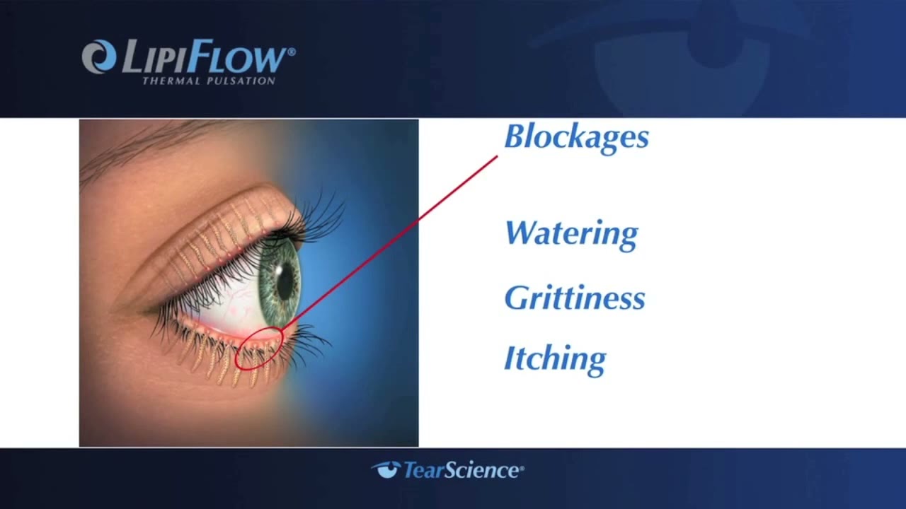 Lipiflow   Dry Eye Therapy at the Gavin Herbert Eye Institute, UC Irvine