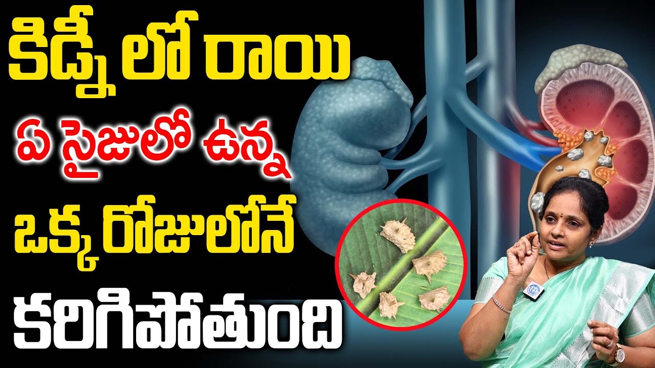 గొంతులో పడగానే కిడ్నీలో 10MM సైజు రాయిని కూడా పిండి పిండి చేస్తుంది |  Kidney Stones | Dr Lakshmi