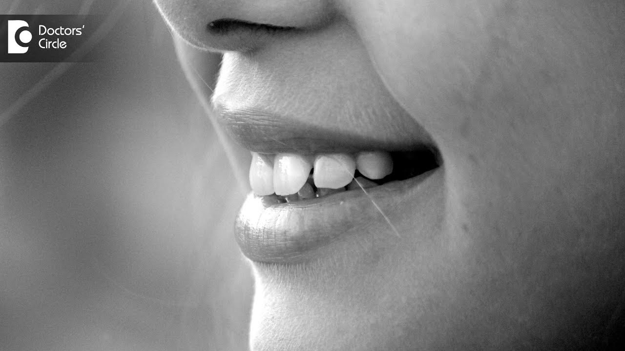 What is a linea alba or Frictional Keratosis in the mouth & its management? -Dr. Arundati Krishnaraj