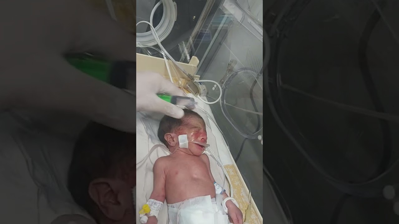 العناية اليومية للعينين لطفل حديثى الولادة.