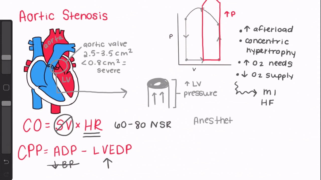 Anesthesia Implications for Aortic Stenosis