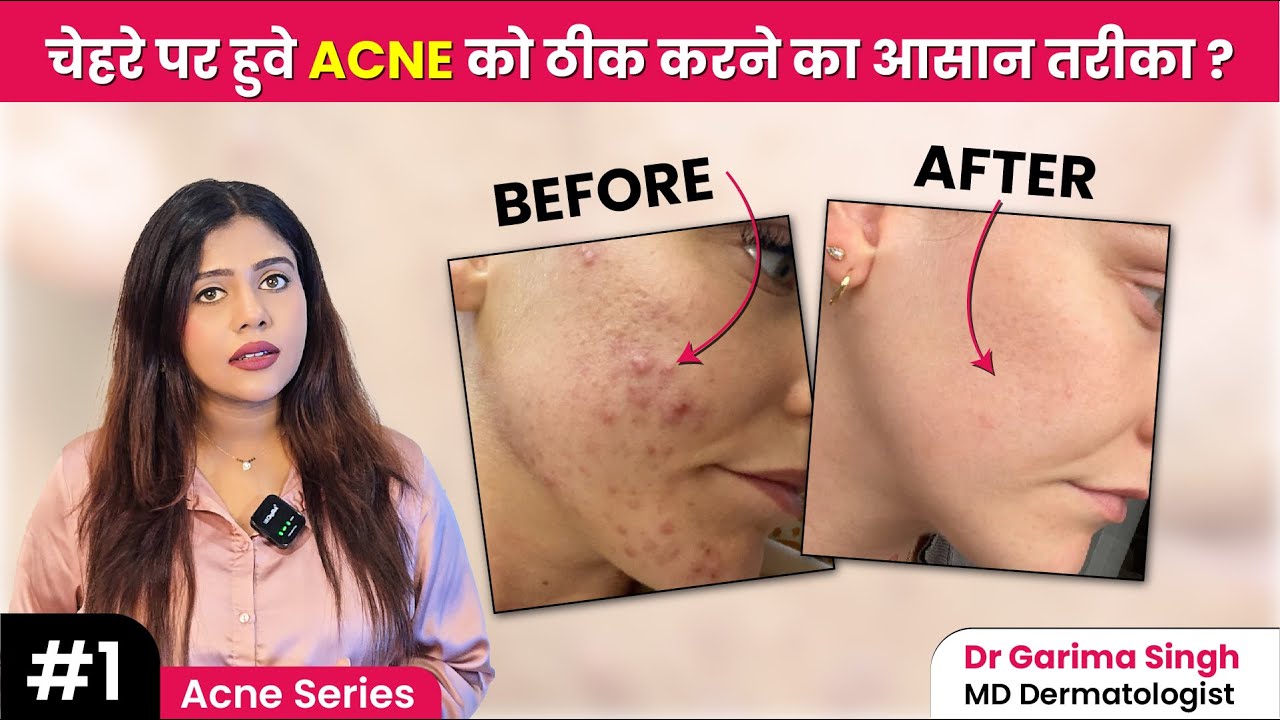 Acne Ku Hota Hai? | Face Par Acne Hone Ka Asli Reason Kya Hai? | Acne Treatment By Dermatologist