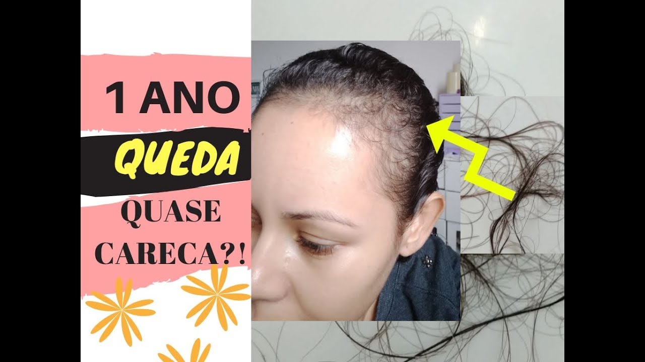 1 ANO DE QUEDA CAPILAR!