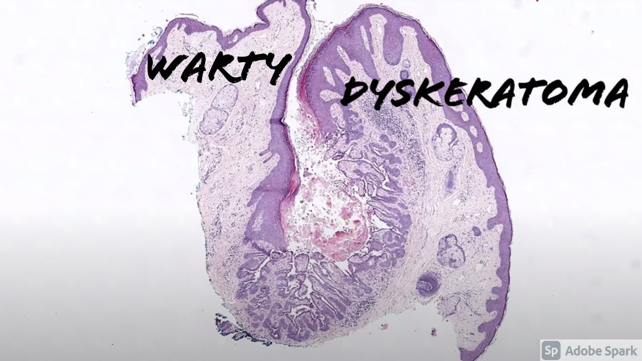 Warty Dyskeratoma: 5-Minute Pathology Pearls