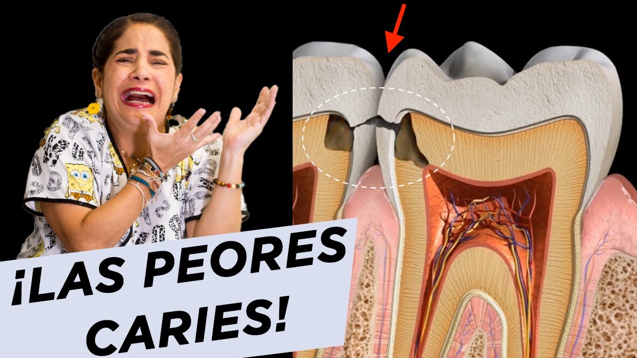 ¡Las peores caries!