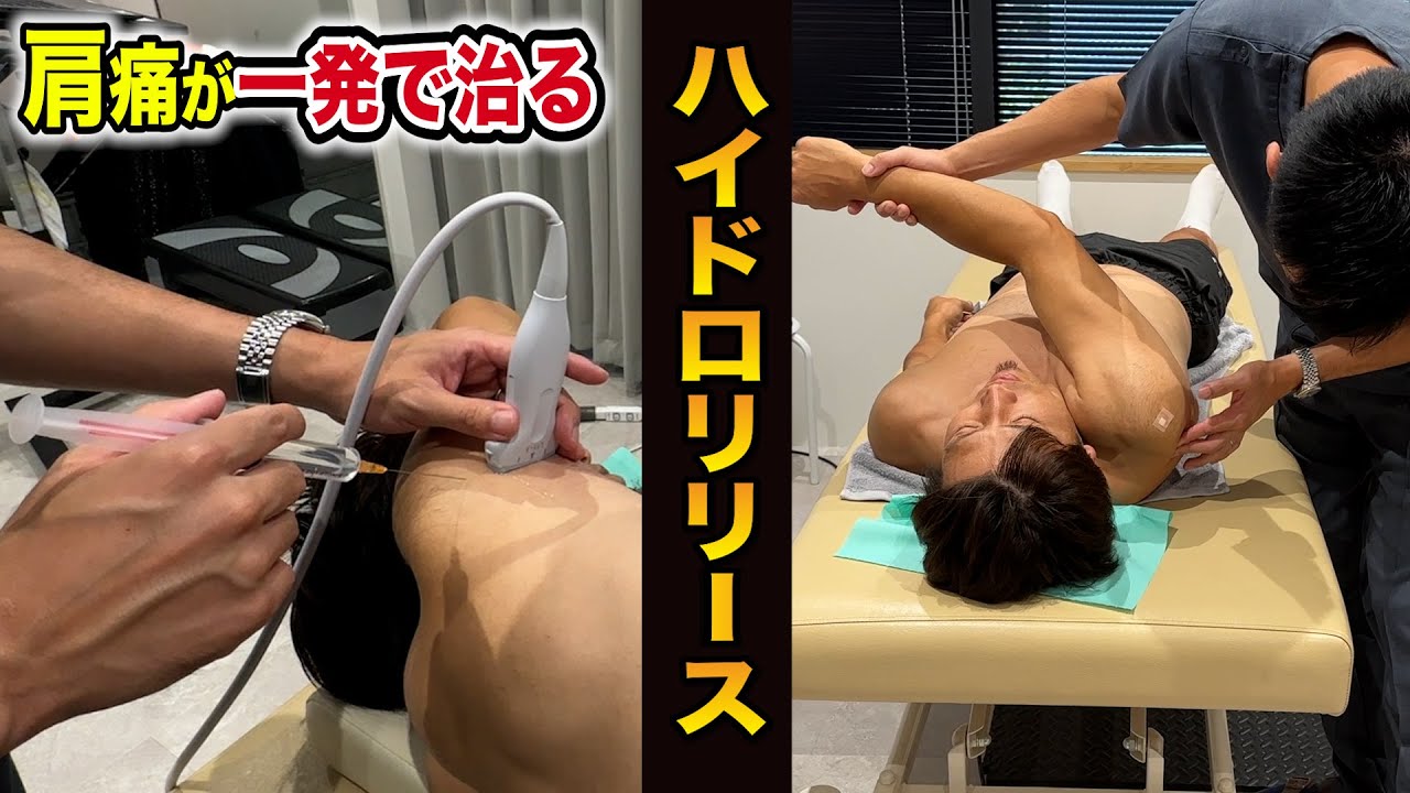 肩痛が即日とれる！ハイドロリリースの効果が絶大すぎた。