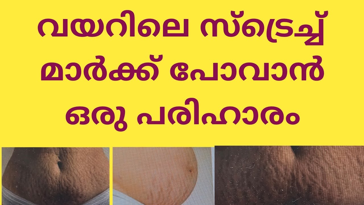 വയറിലെ സ്ട്രെച്ച് മാർക്ക് പോവാൻ ഒരു പരിഹാരം @naushadrayamarathil