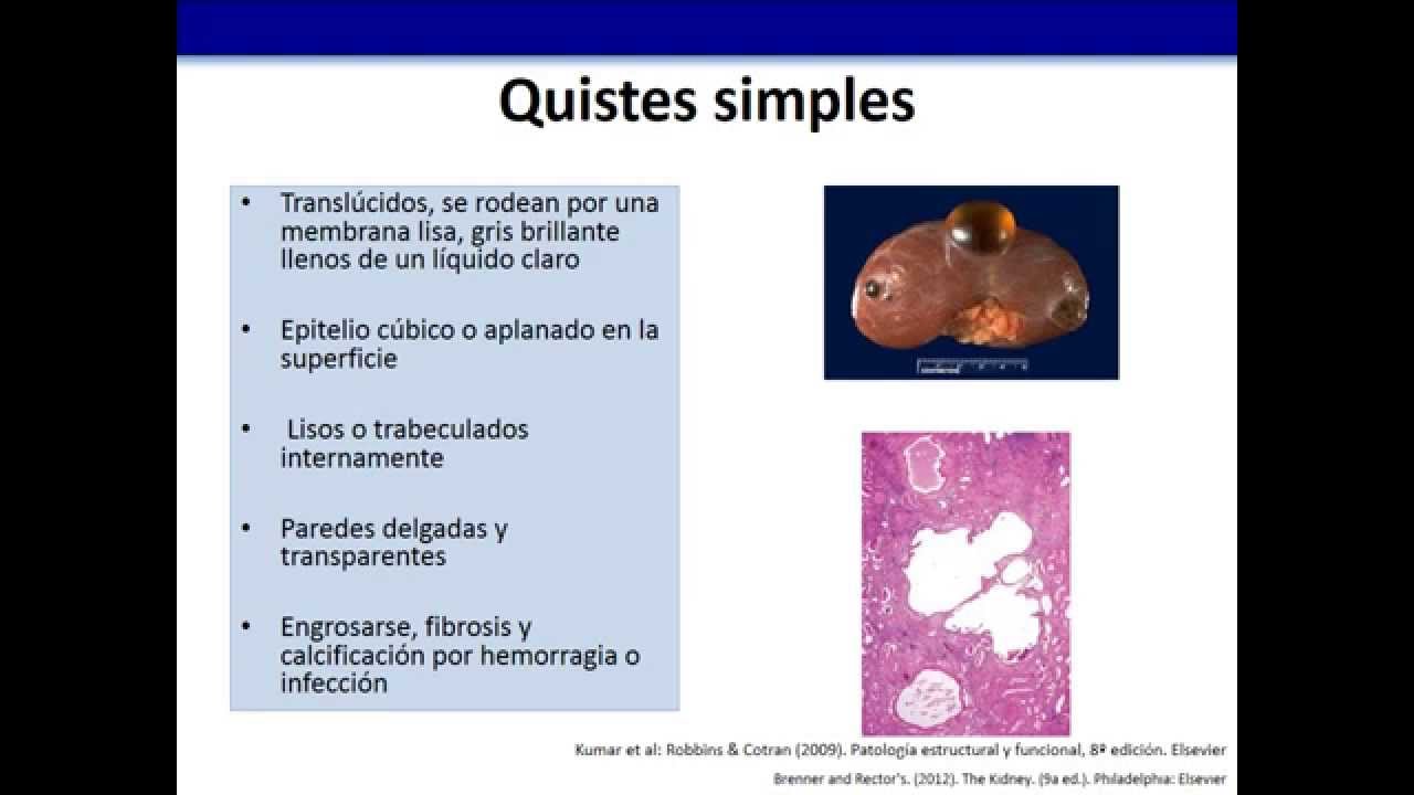Enfermedades Poliquísticas Renales- ITESM Campus Guadalajara MC