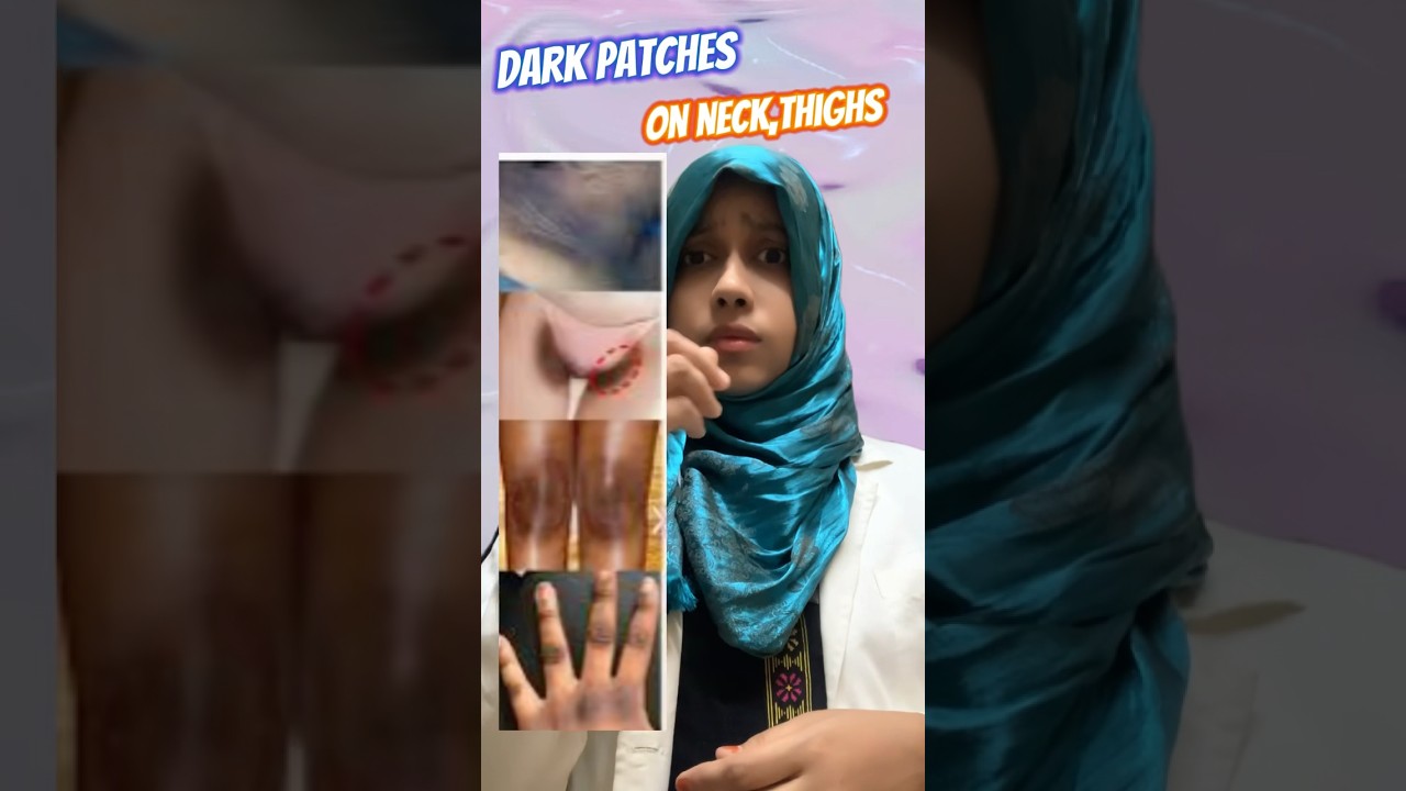 Glow cream 🤩for dark patchy skin 💯results #darkinner thighs #dermatology #darkneck #skincare