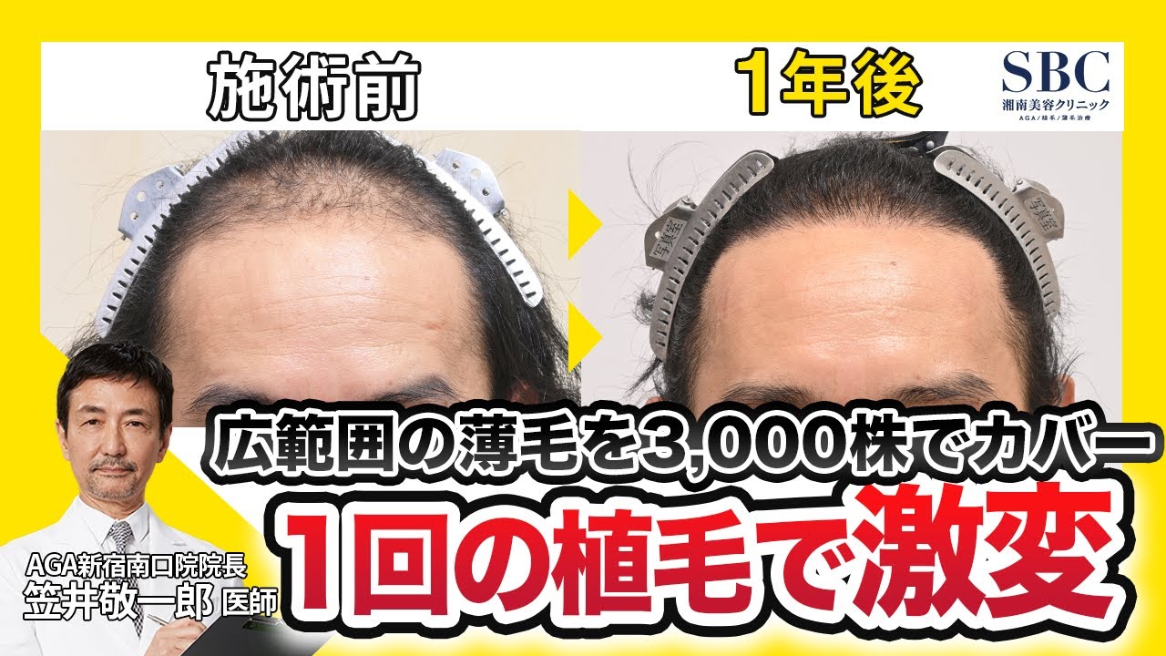 【1回で激変】広範囲の薄毛に3,000株植毛した40代男性の症例解説｜自毛植毛ビフォーアフター