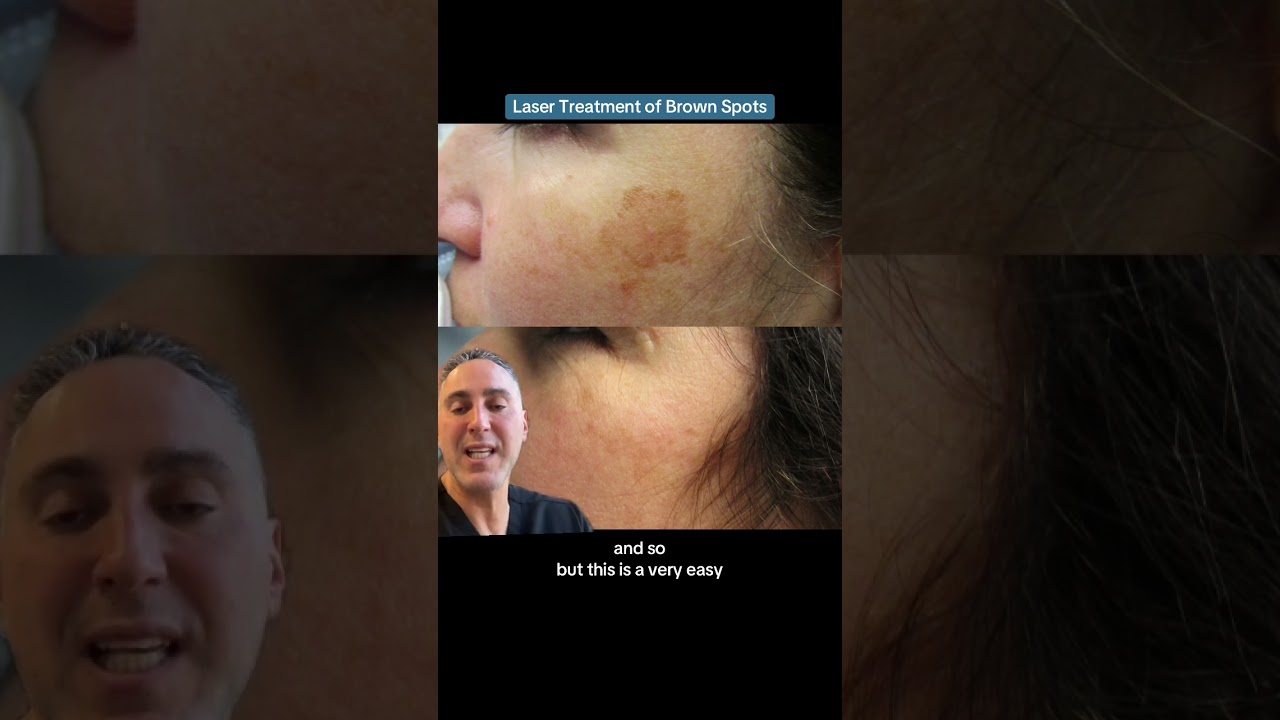 Laser Treatment of Brown Spots