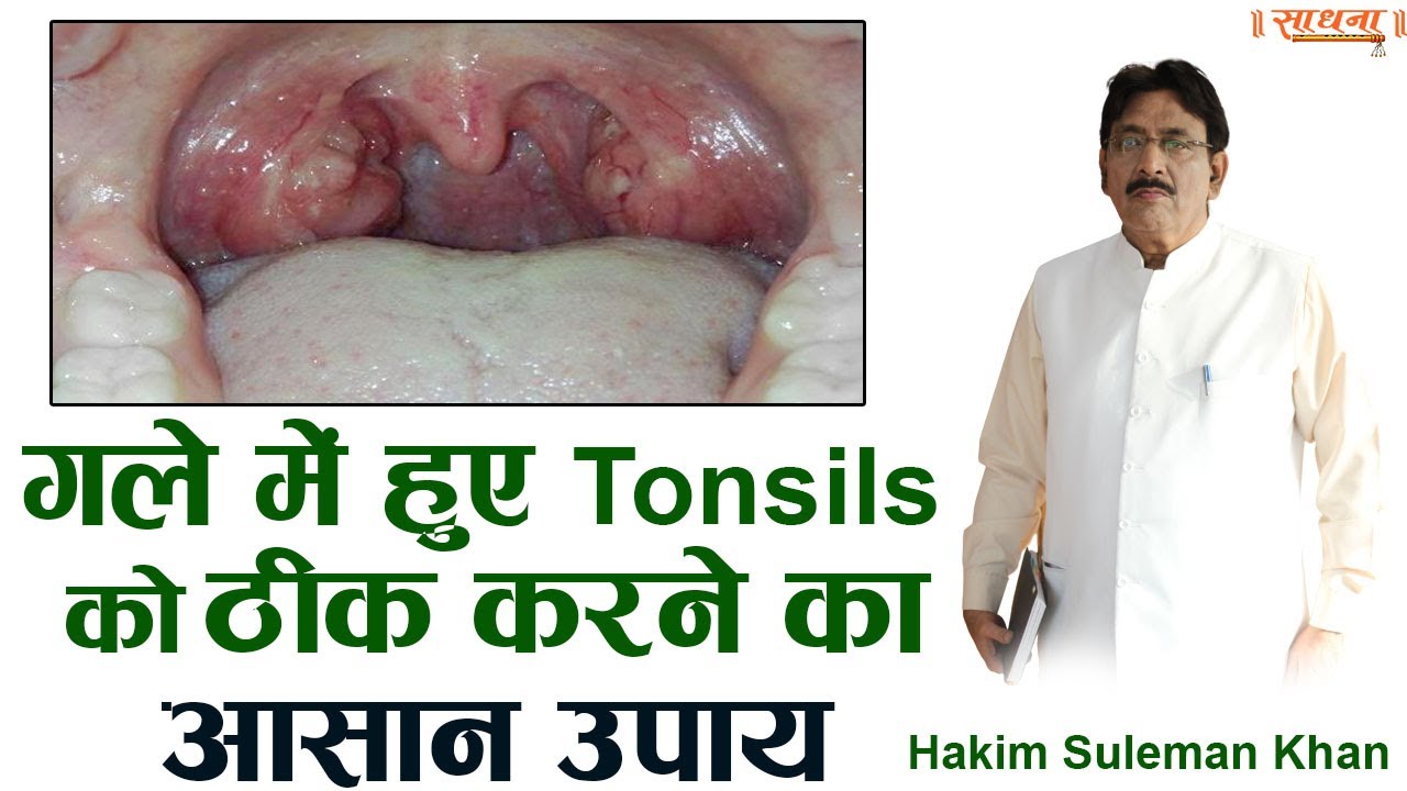 गले में हुए Tonsils को ठीक करने का आसान उपाय। Hakim Suleman Khan | Sadhna TV