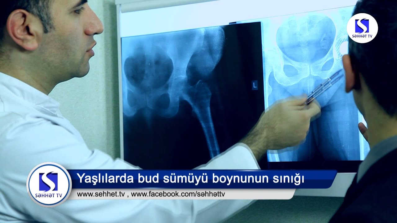 Travmatoloq-Ortoped \ Amir Bədəlov \ Yaşlılarda bud sümüyü boynunun sınığı
