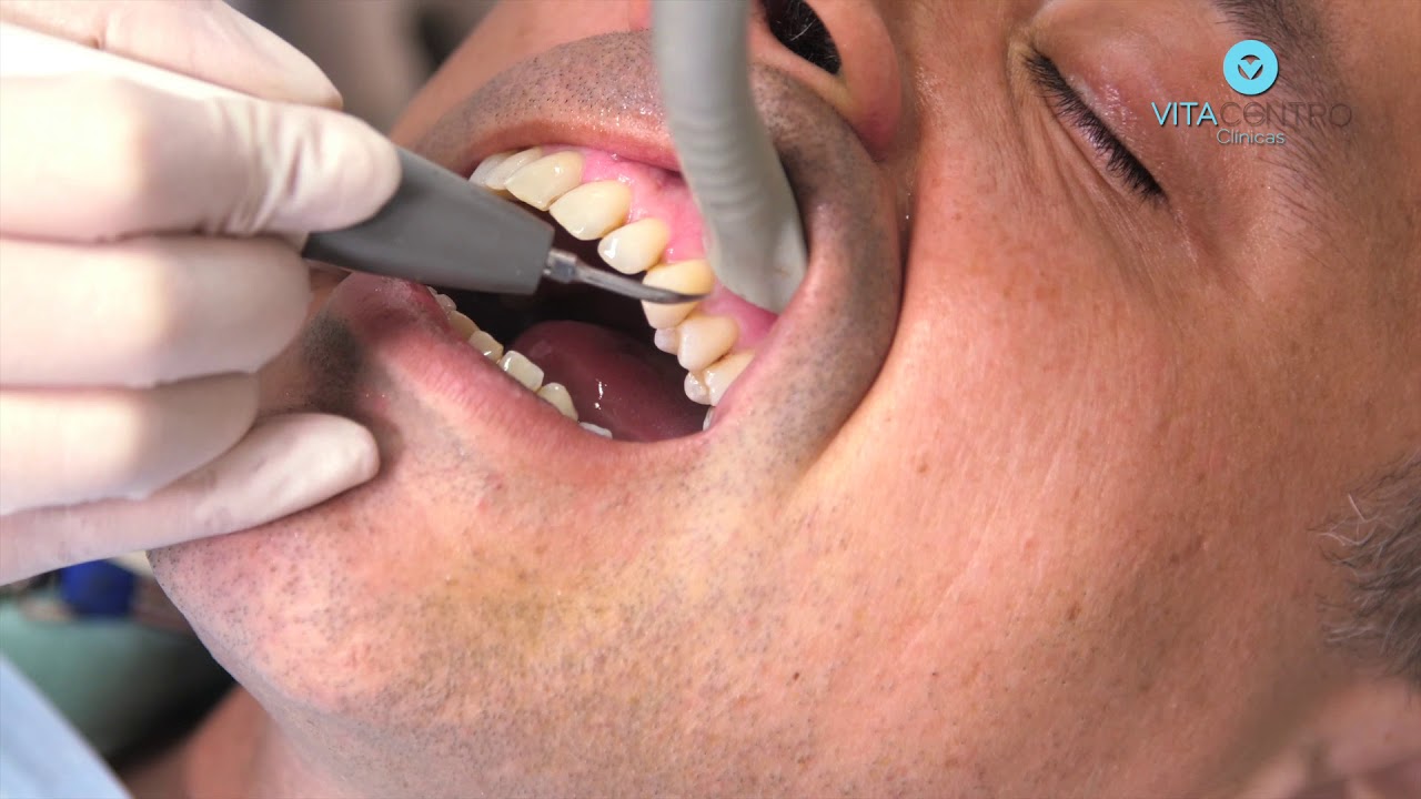 Destartarização, limpeza dos dentes