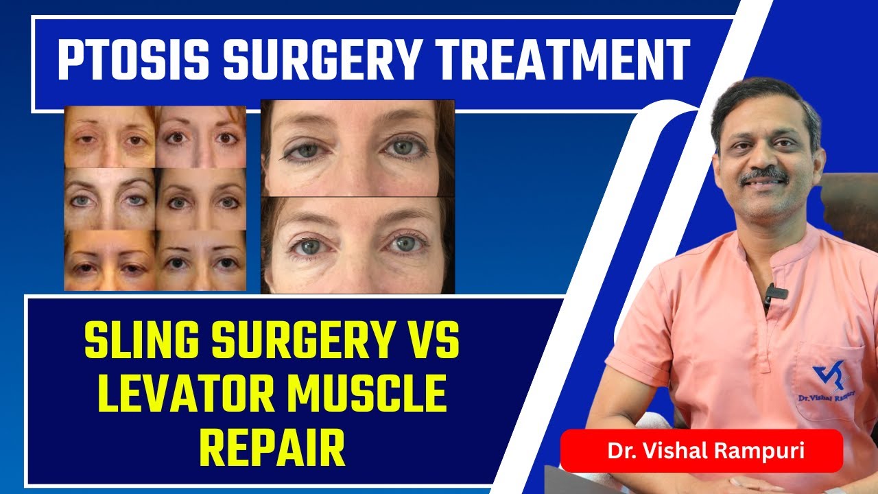 पलकों का झुकना – Ptosis के इलाज के तरीके ? | Sling Surgery VS Levator Muscle Repair