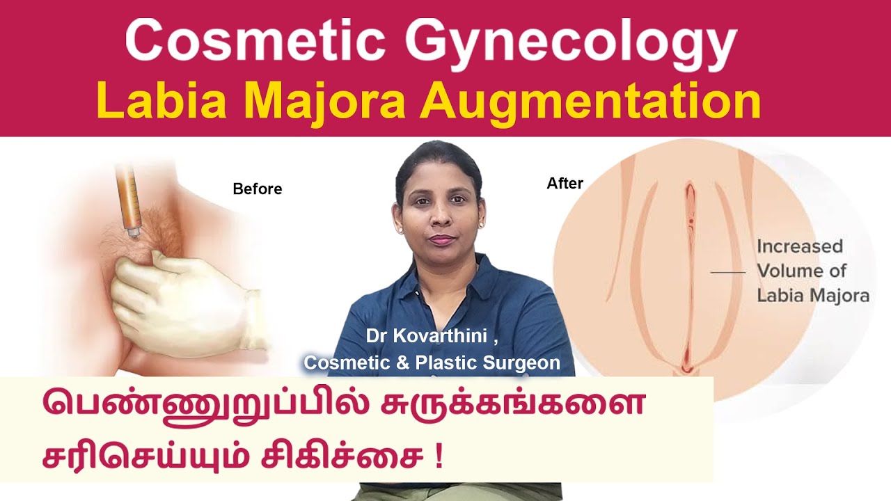 Cosmetic Gynecology | Labia Majora Augmentation | Dr. Kovarthini Cosmetic & Plastic Surgeon