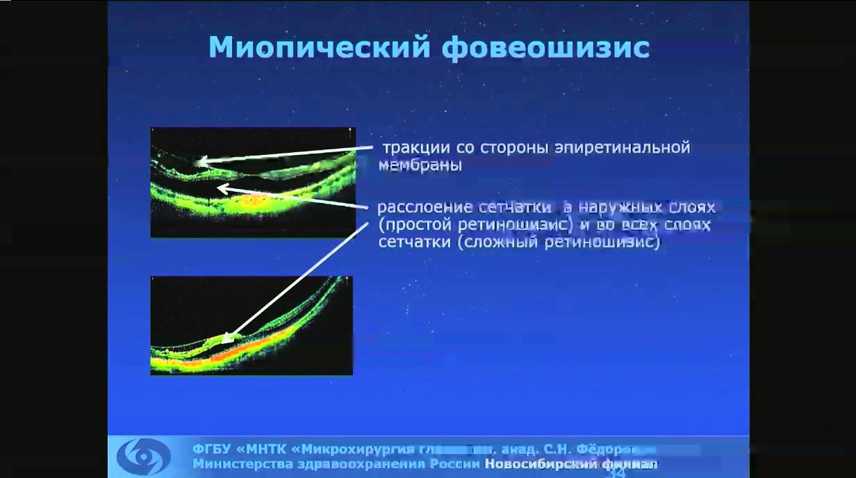 Дулидова В.В. Миопическая макула. ОКТ-диагностика.