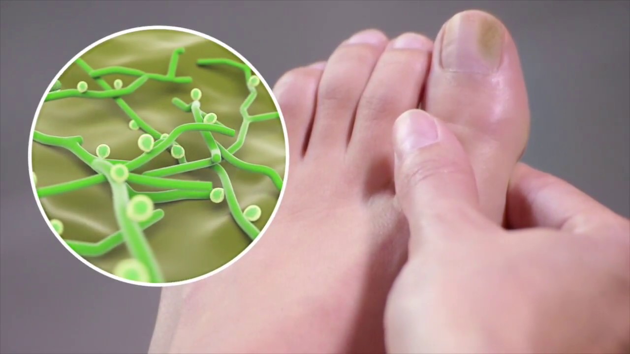 Schollmed Once Weekly* Fungal Nail Treatment