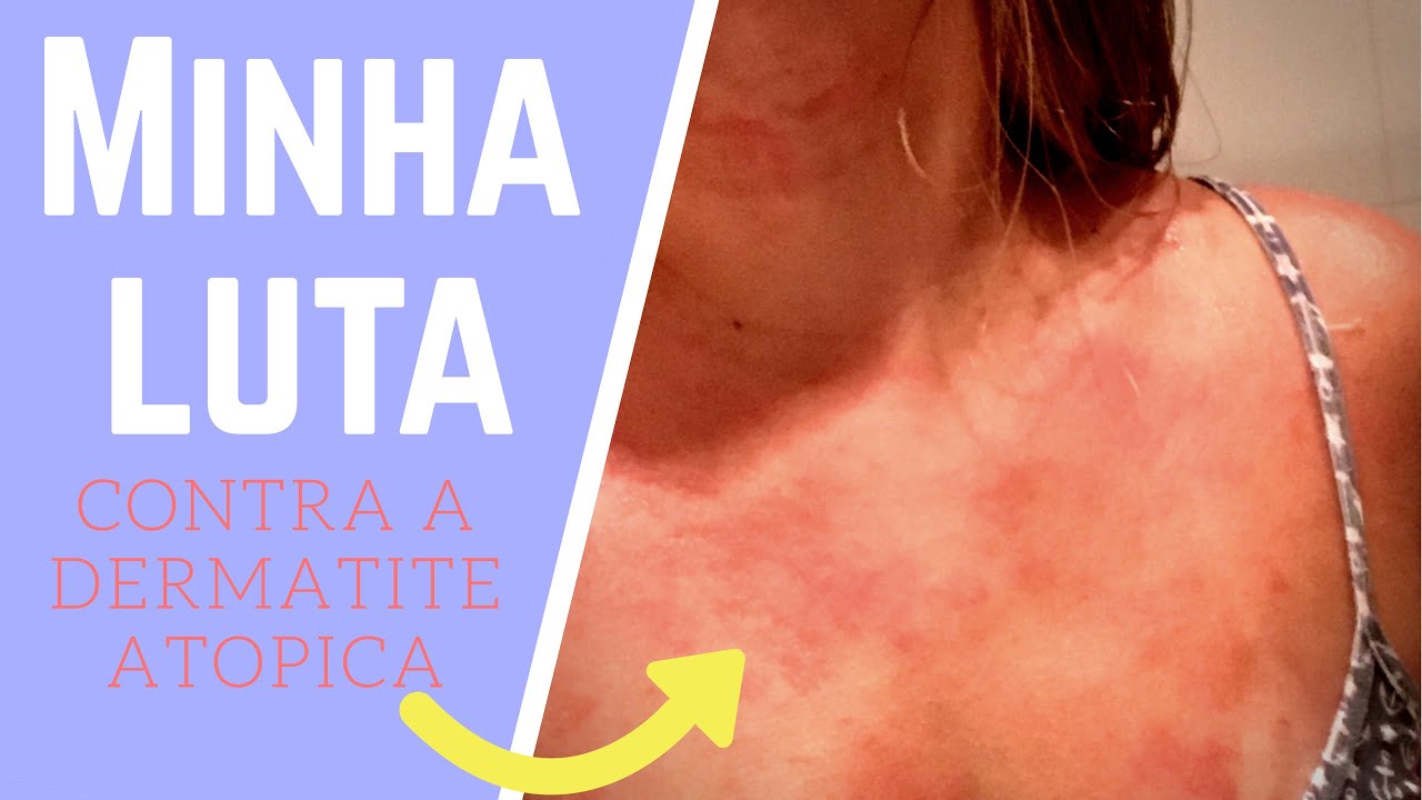 MINHA LUTA CONTRA DERMATITE | Bruna Panizo &hearts;