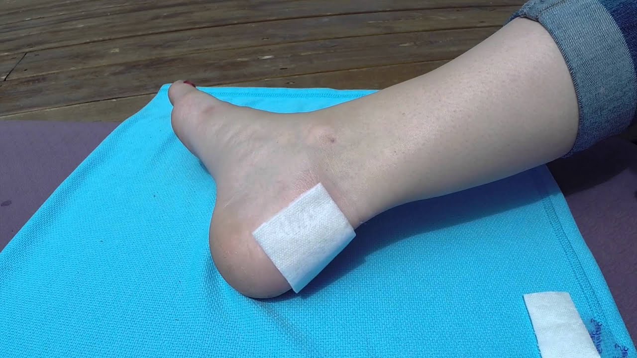 Blister Treatment: Mepital, Telfa, and Leukotape