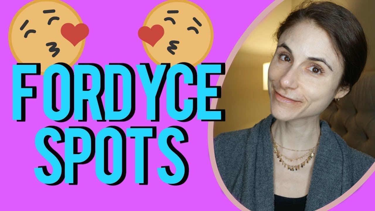 Fordyce spots| Q&A with dermatologist Dr Dray