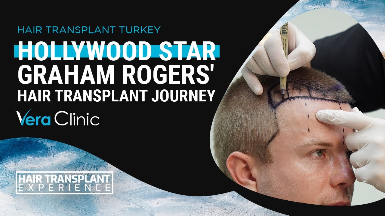 Hollywood Star Graham Rogers' Hair Transplant Journey #hairtransplant #hairtransplantturkey