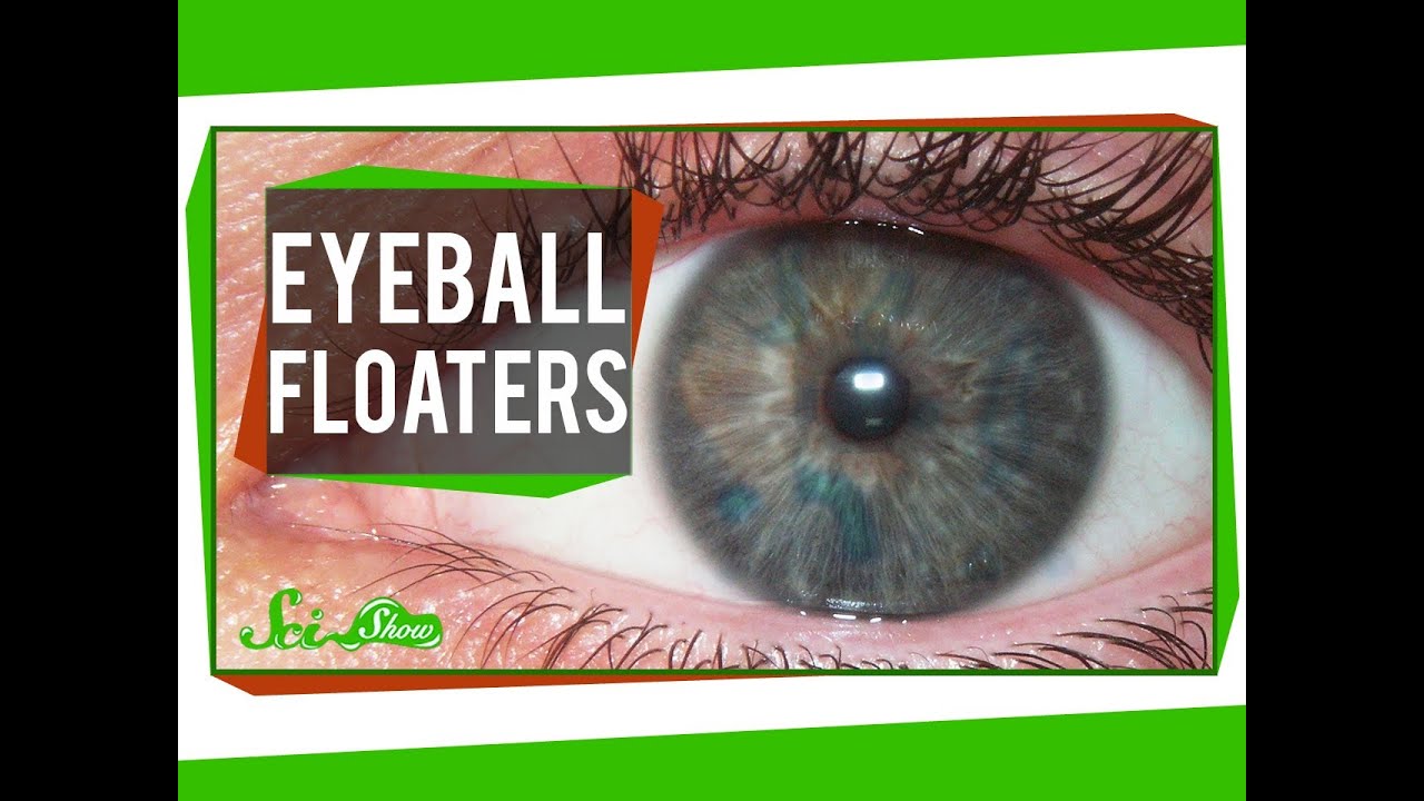 Those Maddening Eyeball Floaters!