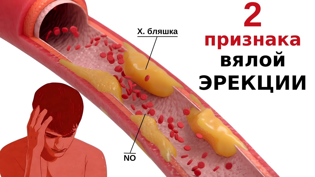 Что делать, если холестерин застрял в сосудах пениса