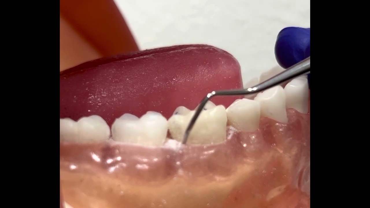 Universal Curette Barnhart 5/6- Posterior Teeth