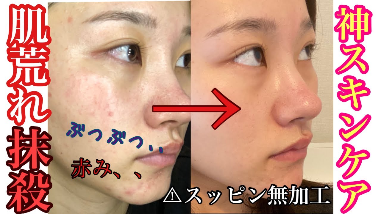 【肌荒れ抹消】ブツボコ肌からツルスベちゅるん肌に生まれ変わった…最強スキンケアはこれだ！！